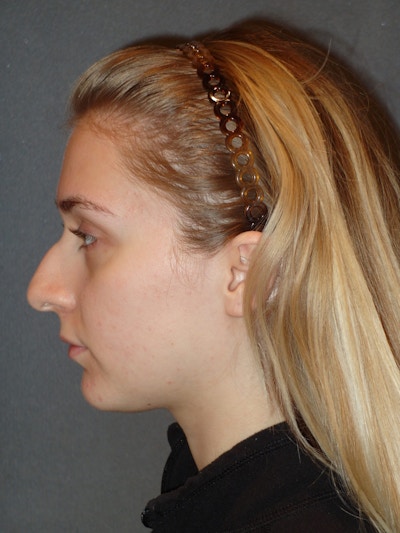 Rhinoplasty Before & After Gallery - Patient 208247 - Image 1