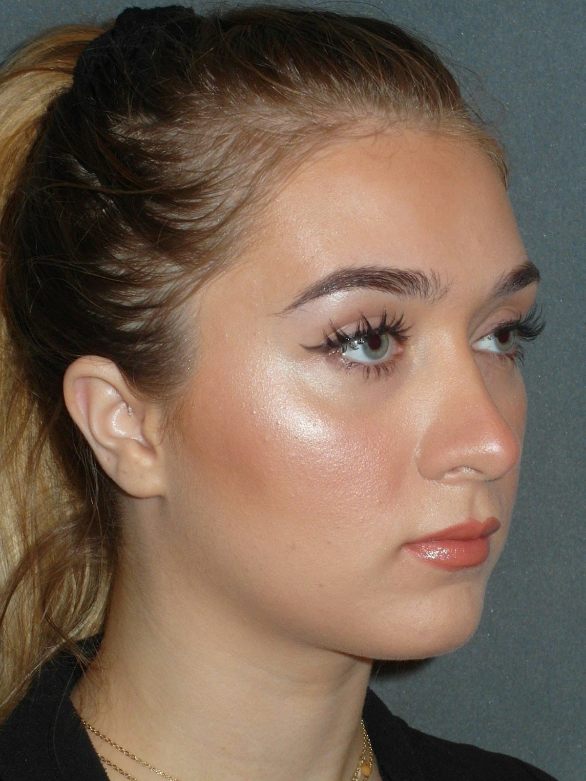 Rhinoplasty Before & After Gallery - Patient 208247 - Image 6
