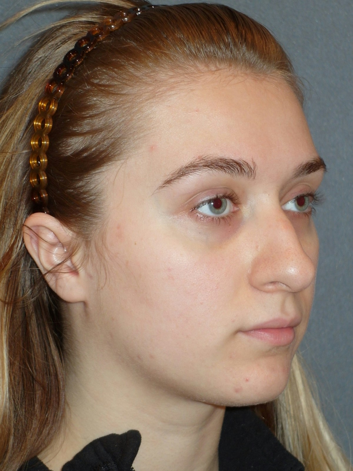 Rhinoplasty Before & After Gallery - Patient 208247 - Image 5