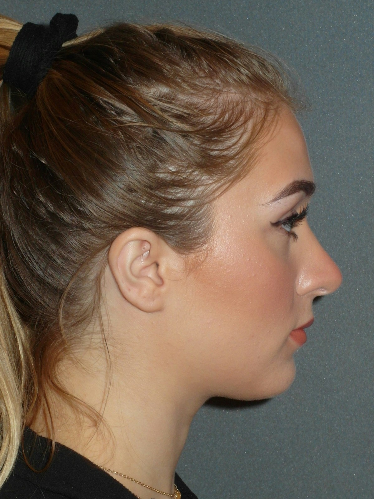 Rhinoplasty Before & After Gallery - Patient 208247 - Image 10