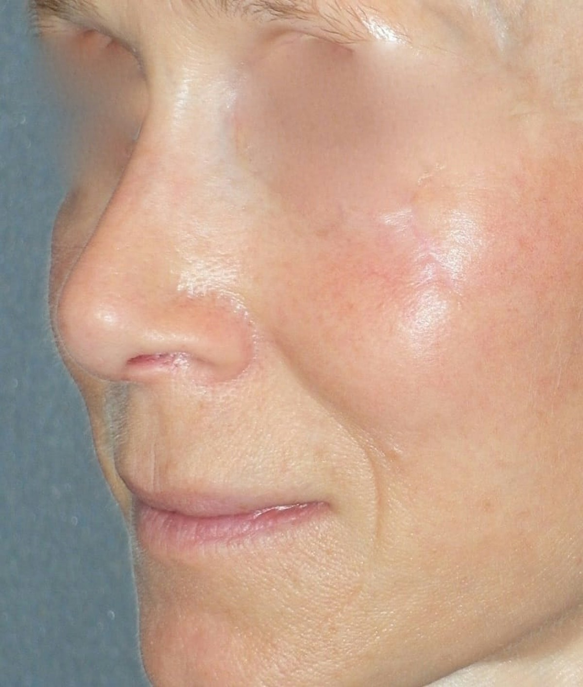 Rhinoplasty Before & After Gallery - Patient 544416 - Image 4