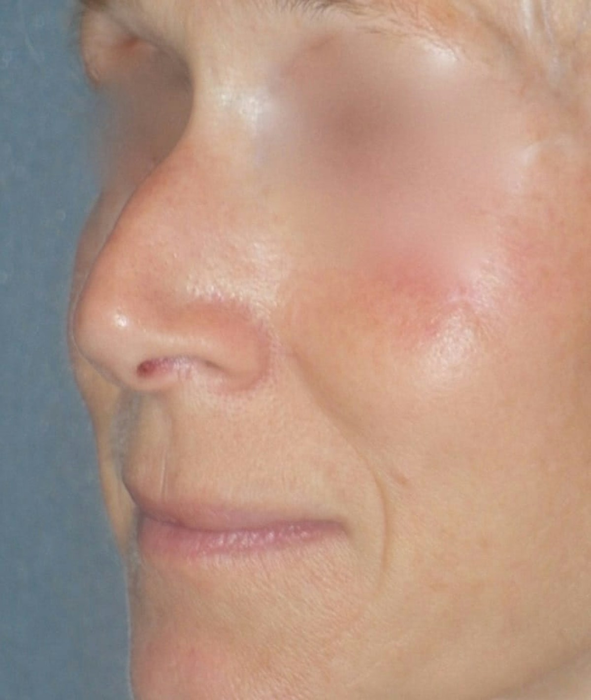 Rhinoplasty Before & After Gallery - Patient 544416 - Image 3