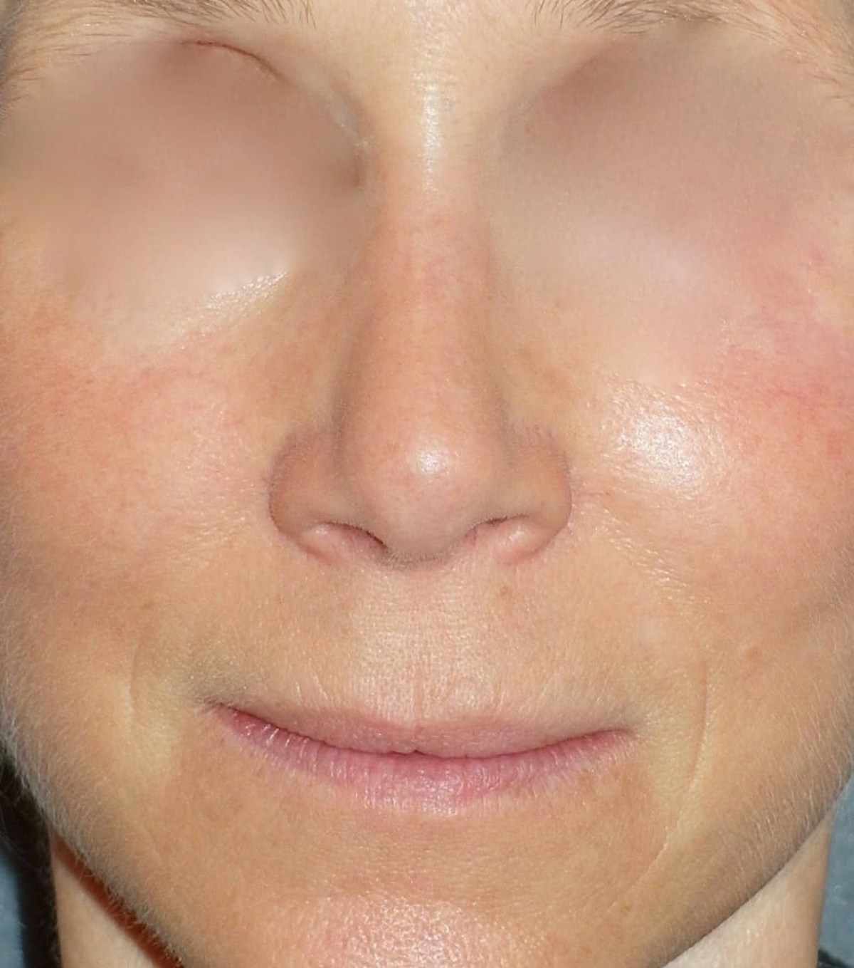 Rhinoplasty Before & After Gallery - Patient 544416 - Image 2