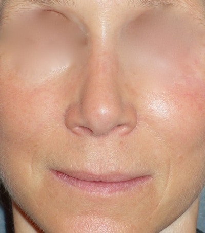 Rhinoplasty Before & After Gallery - Patient 544416 - Image 2
