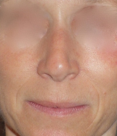 Rhinoplasty Before & After Gallery - Patient 544416 - Image 1