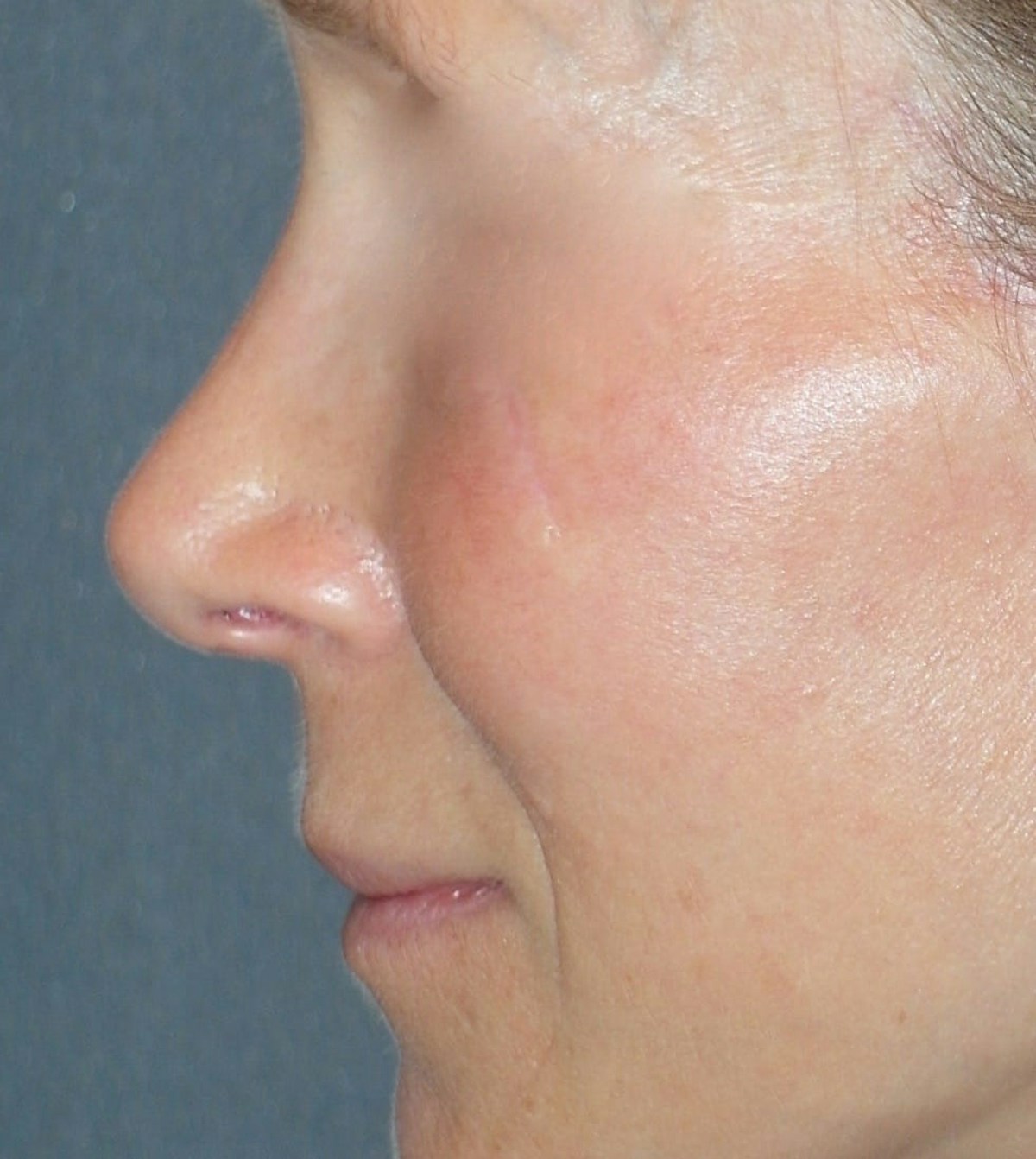 Rhinoplasty Before & After Gallery - Patient 544416 - Image 6