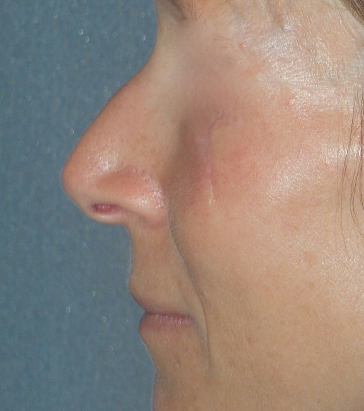Rhinoplasty Before & After Gallery - Patient 544416 - Image 5