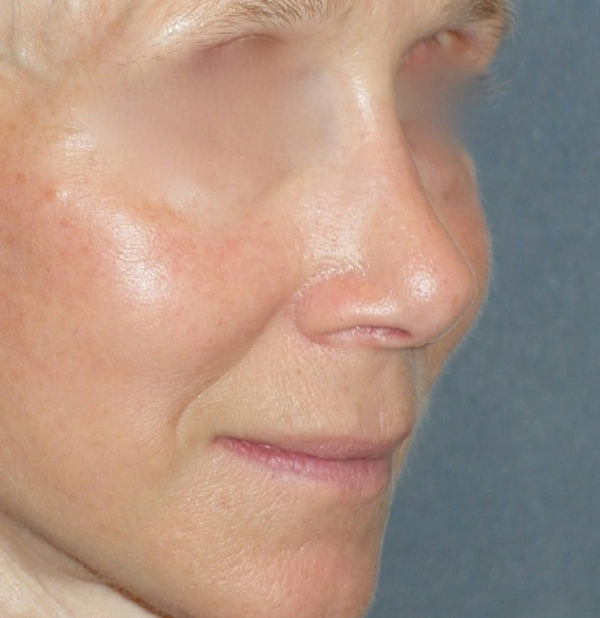 Rhinoplasty Before & After Gallery - Patient 544416 - Image 8