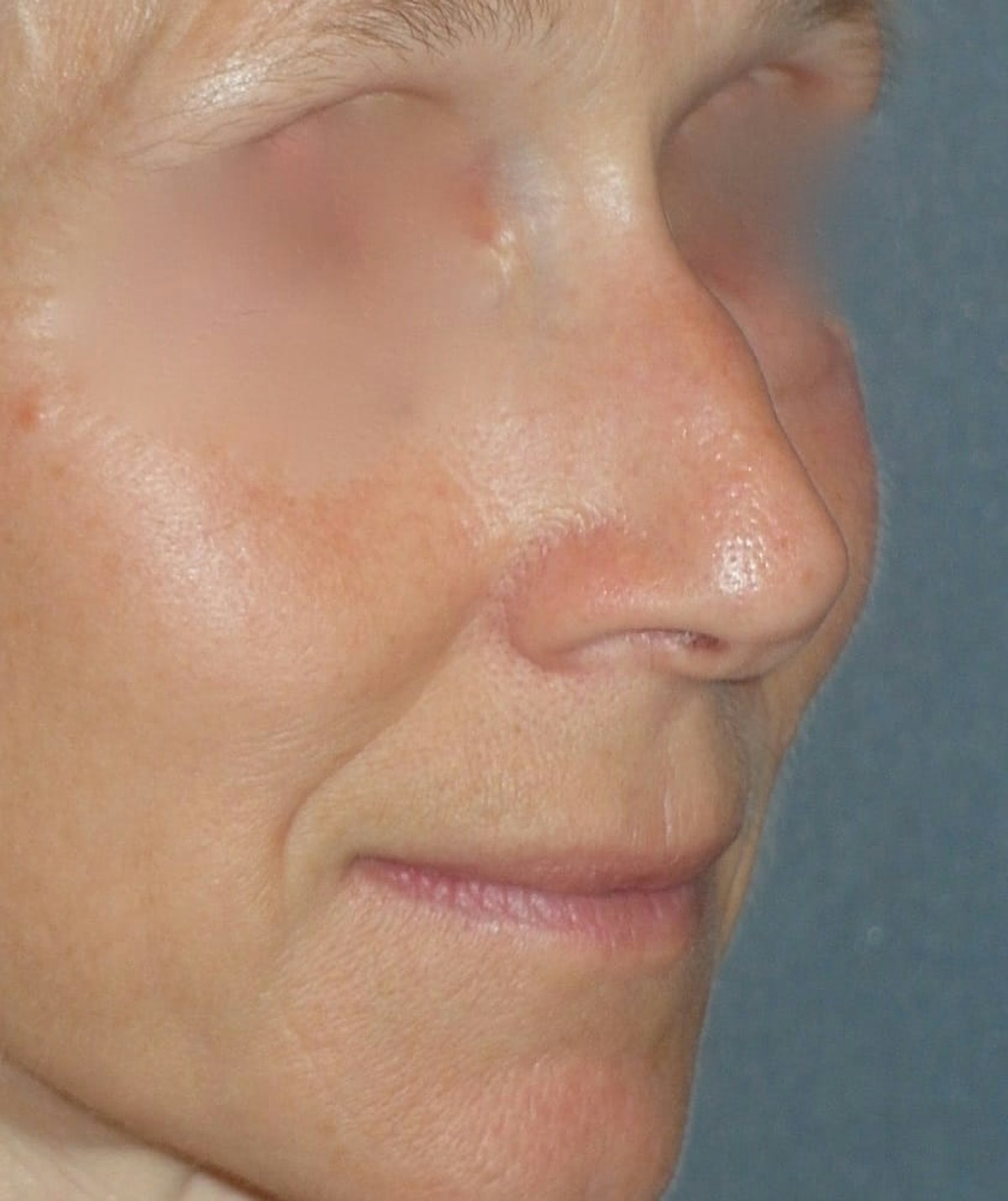 Rhinoplasty Before & After Gallery - Patient 544416 - Image 7