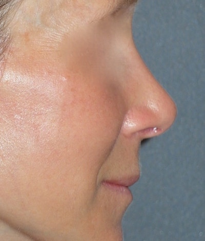 Rhinoplasty Before & After Gallery - Patient 544416 - Image 2