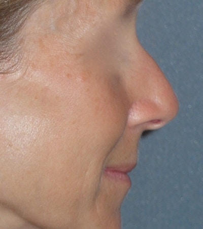 Rhinoplasty Before & After Gallery - Patient 544416 - Image 1