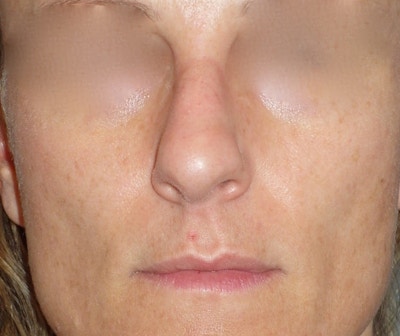 Rhinoplasty Before & After Gallery - Patient 343299 - Image 1