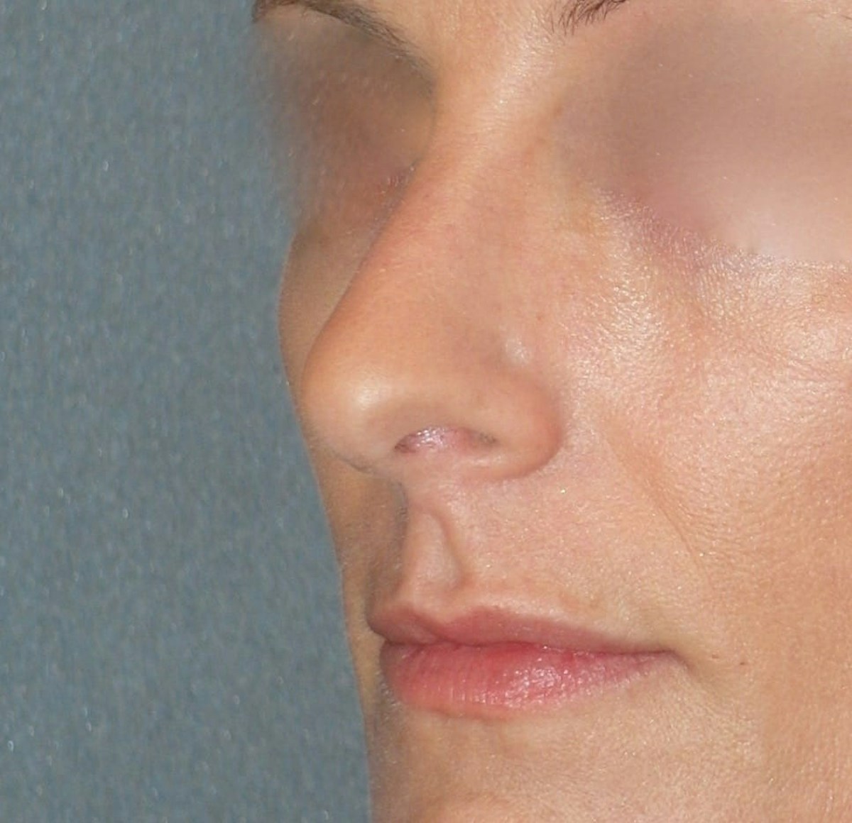 Rhinoplasty Before & After Gallery - Patient 343299 - Image 4