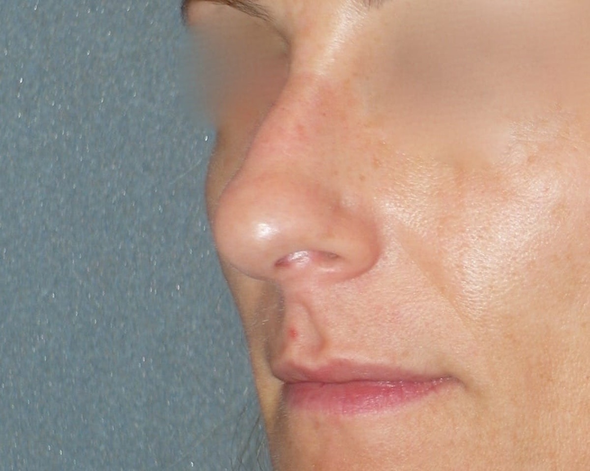 Rhinoplasty Before & After Gallery - Patient 343299 - Image 3