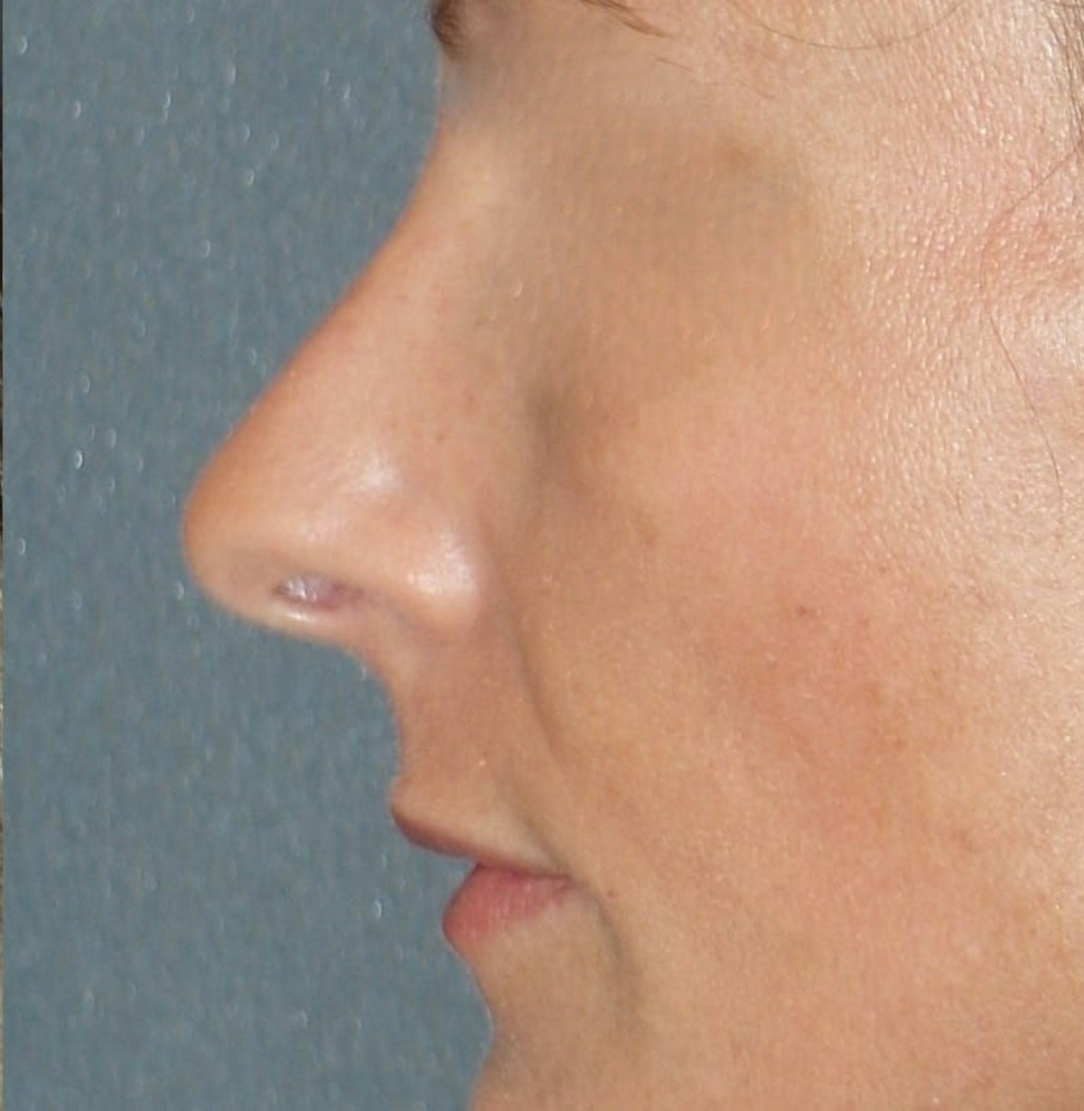 Rhinoplasty Before & After Gallery - Patient 343299 - Image 10