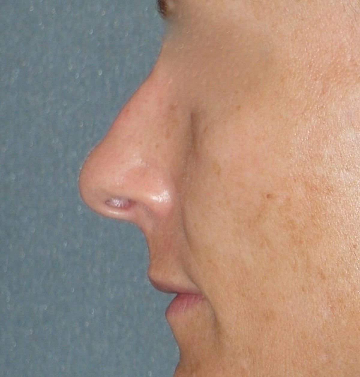 Rhinoplasty Before & After Gallery - Patient 343299 - Image 9