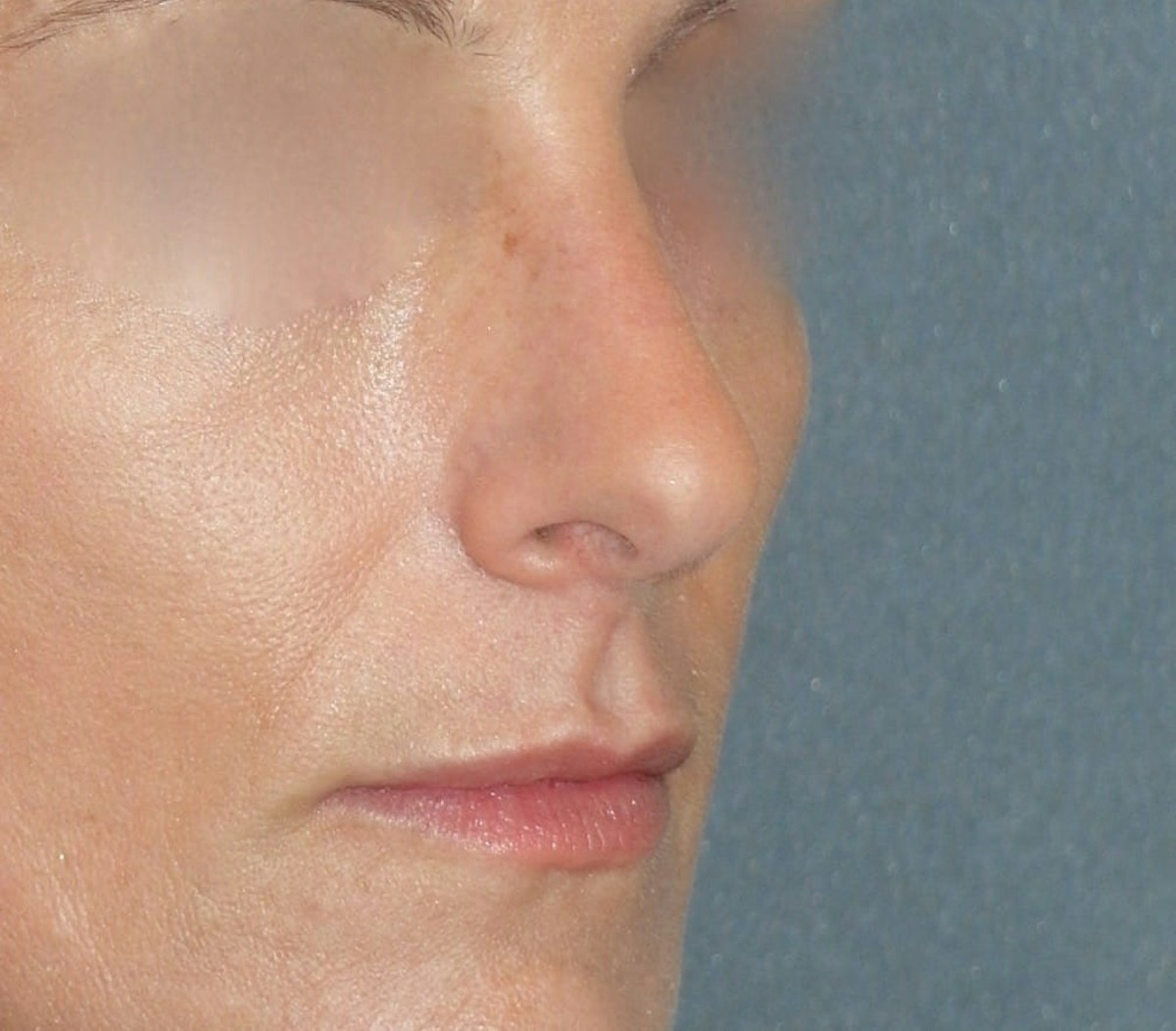 Rhinoplasty Before & After Gallery - Patient 343299 - Image 6