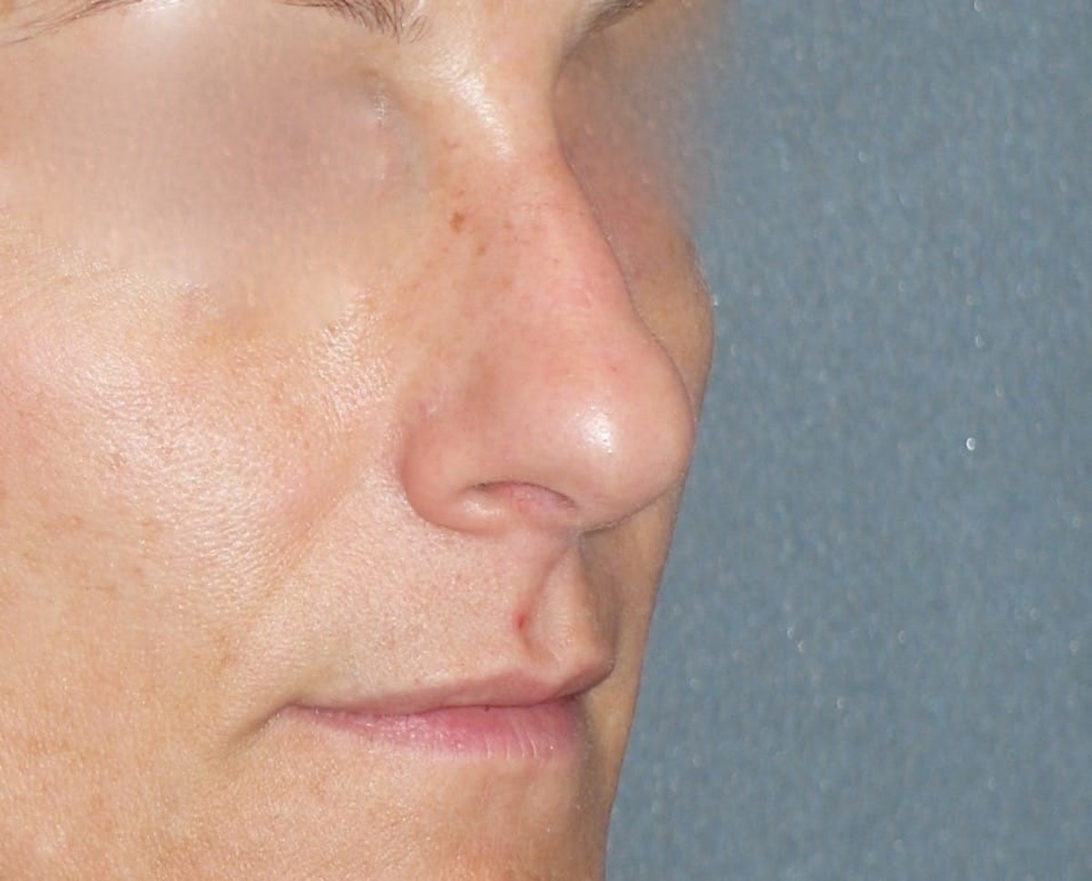 Rhinoplasty Before & After Gallery - Patient 343299 - Image 5