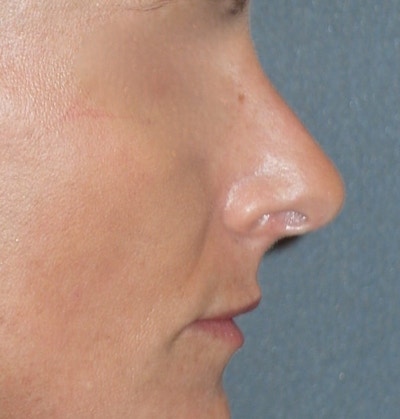 Rhinoplasty Before & After Gallery - Patient 343299 - Image 2