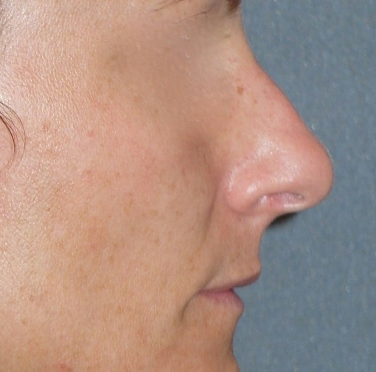 Rhinoplasty Before & After Gallery - Patient 343299 - Image 7