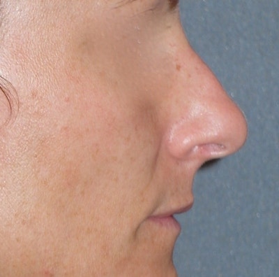 Rhinoplasty Before & After Gallery - Patient 343299 - Image 1
