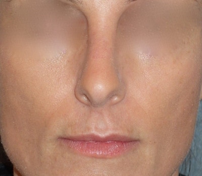 Rhinoplasty Before & After Gallery - Patient 343299 - Image 2