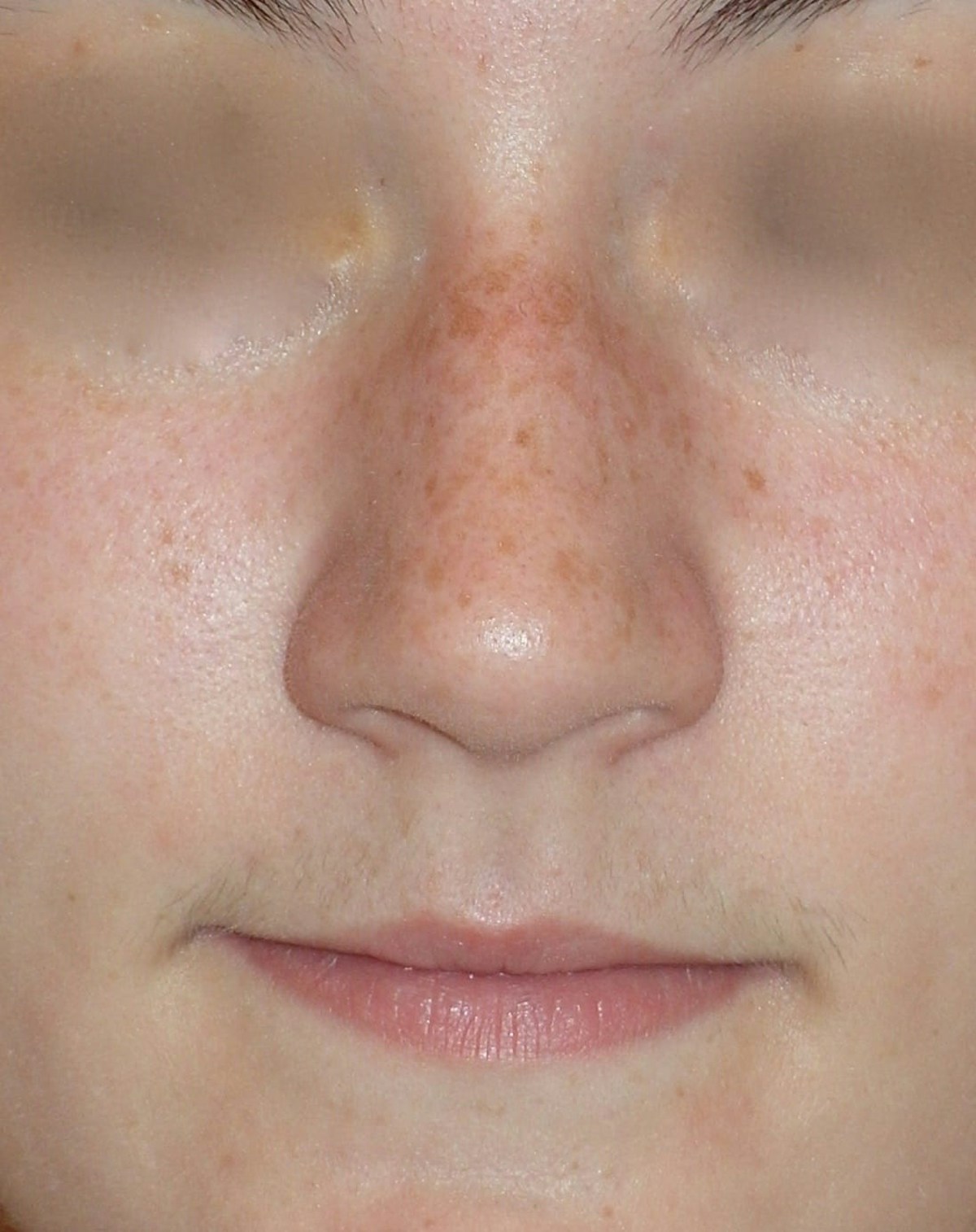 Rhinoplasty Before & After Gallery - Patient 314505 - Image 1