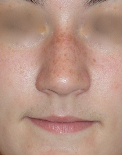 Rhinoplasty Before & After Gallery - Patient 314505 - Image 1
