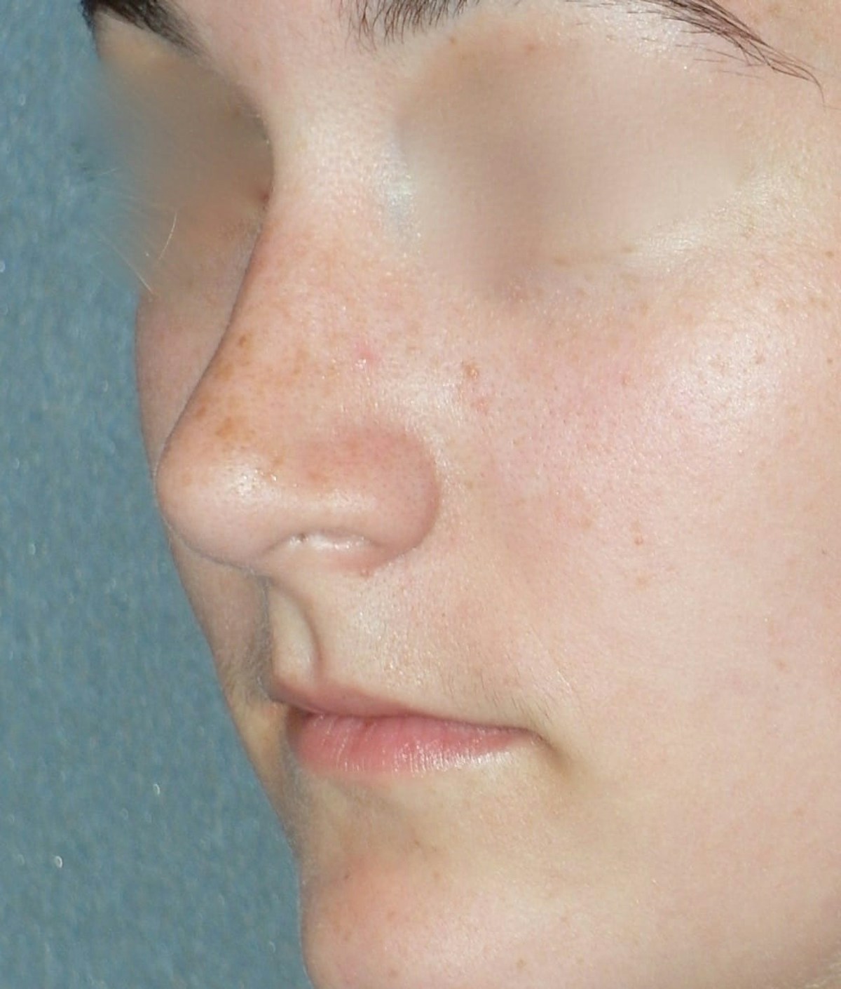 Rhinoplasty Before & After Gallery - Patient 314505 - Image 4