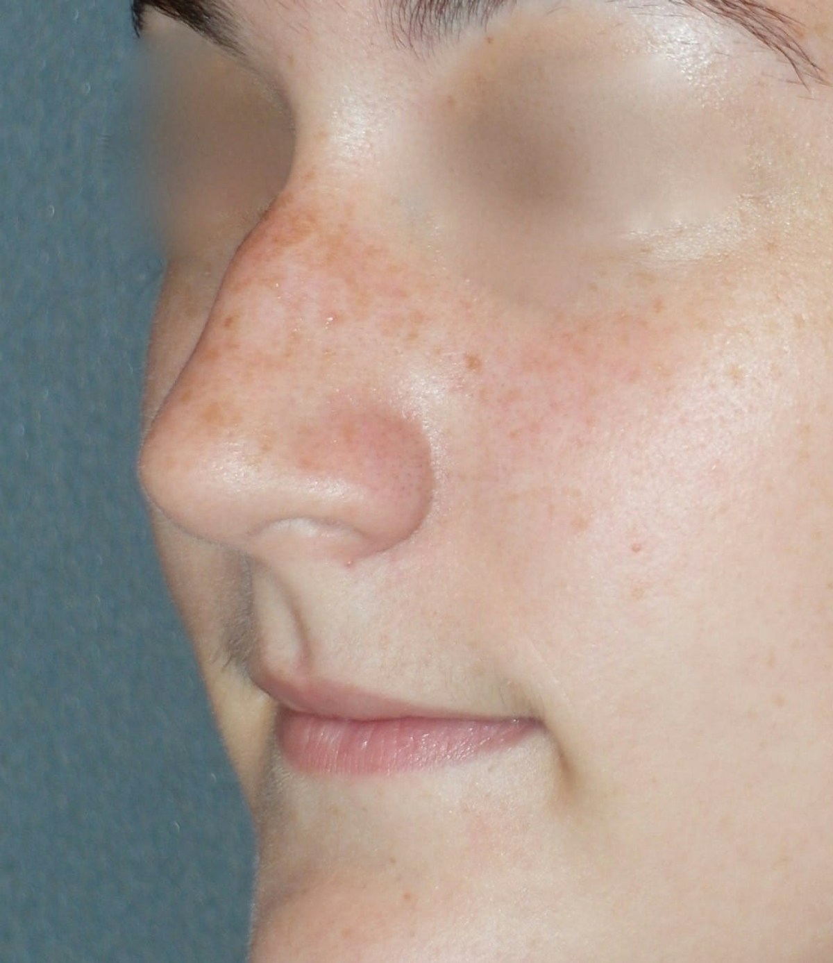 Rhinoplasty Before & After Gallery - Patient 314505 - Image 3