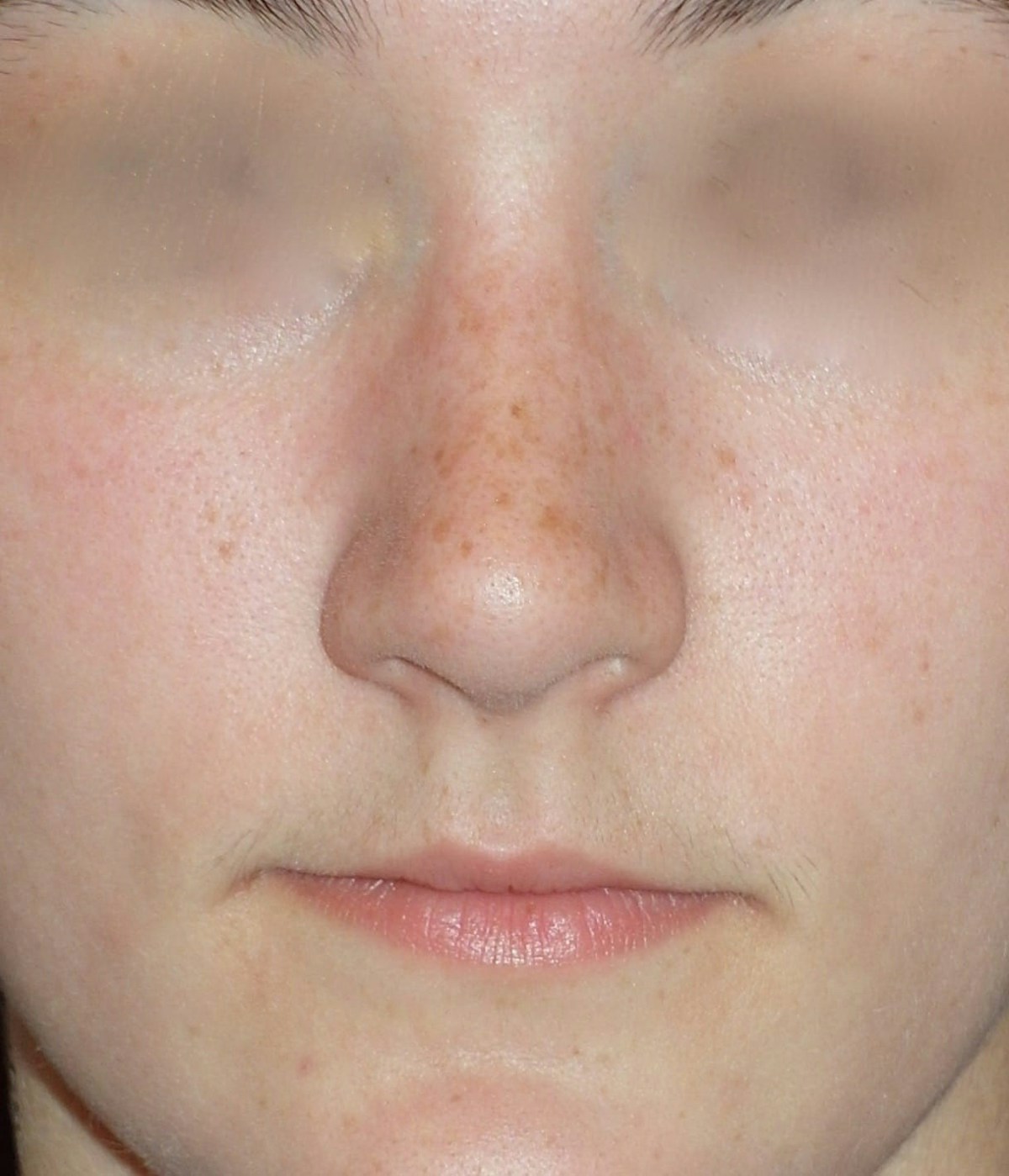 Rhinoplasty Before & After Gallery - Patient 314505 - Image 2