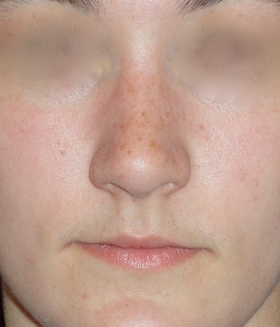 Rhinoplasty Before & After Gallery - Patient 314505 - Image 2