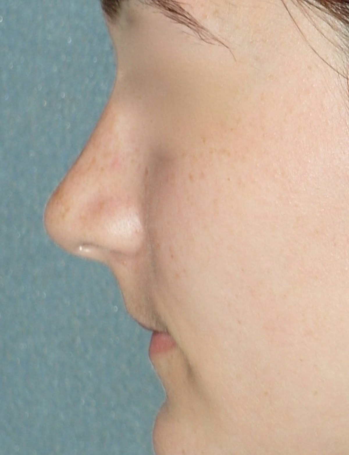 Rhinoplasty Before & After Gallery - Patient 314505 - Image 10