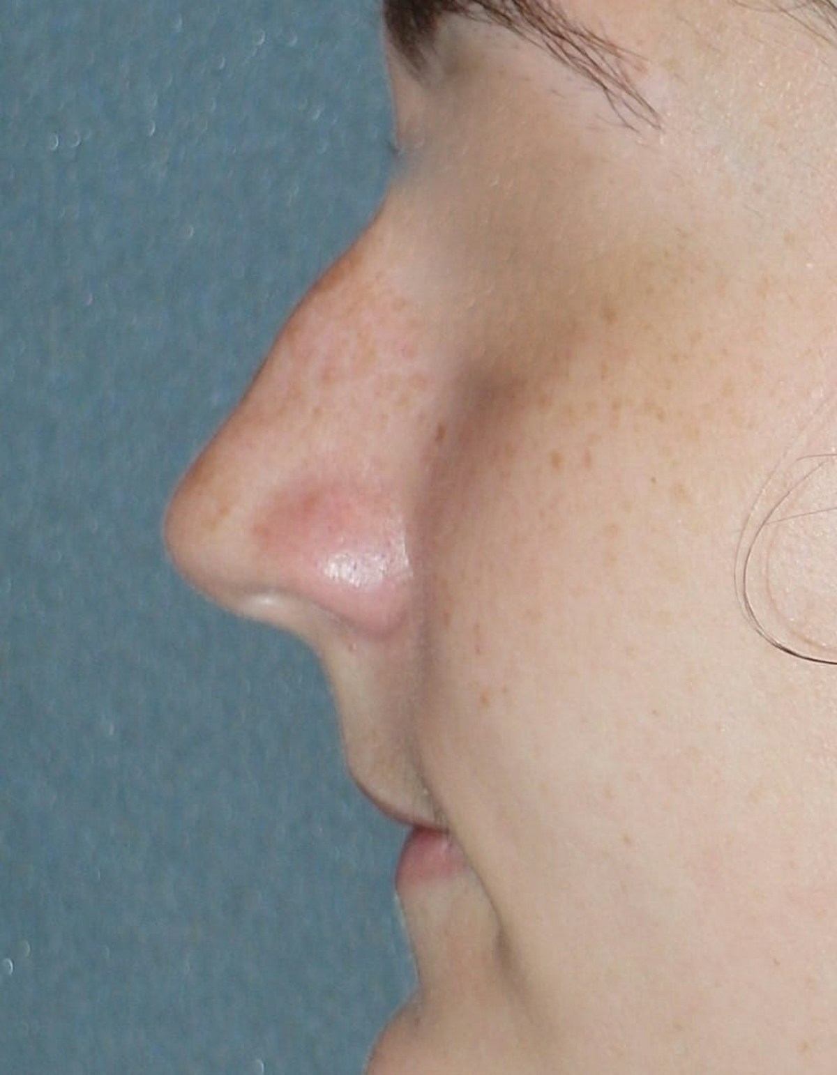 Rhinoplasty Before & After Gallery - Patient 314505 - Image 9