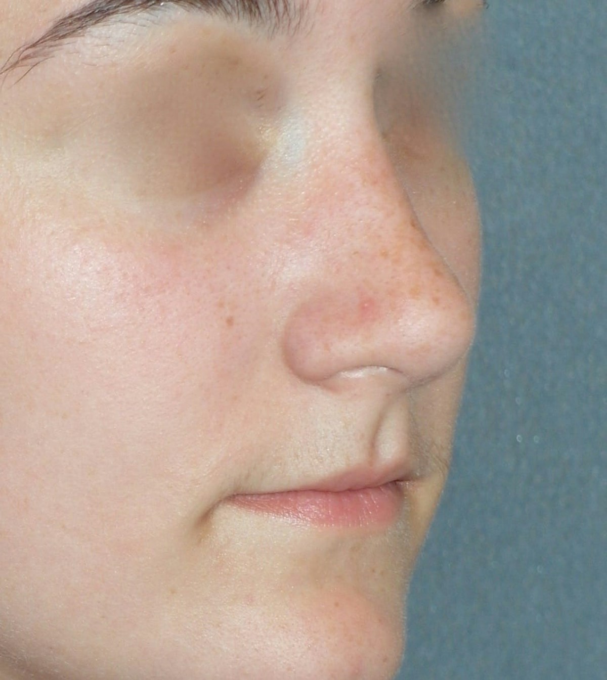 Rhinoplasty Before & After Gallery - Patient 314505 - Image 6