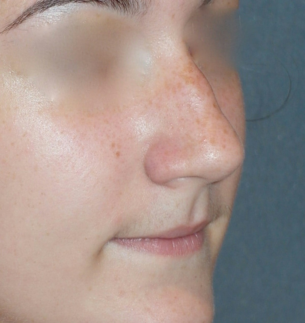 Rhinoplasty Before & After Gallery - Patient 314505 - Image 5