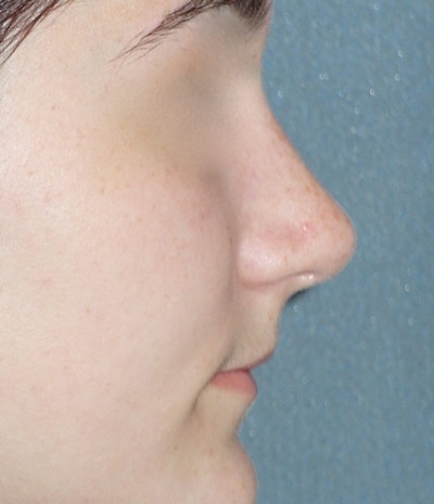 Rhinoplasty Before & After Gallery - Patient 314505 - Image 2