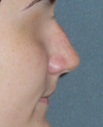 Rhinoplasty Before & After Gallery - Patient 314505 - Image 1