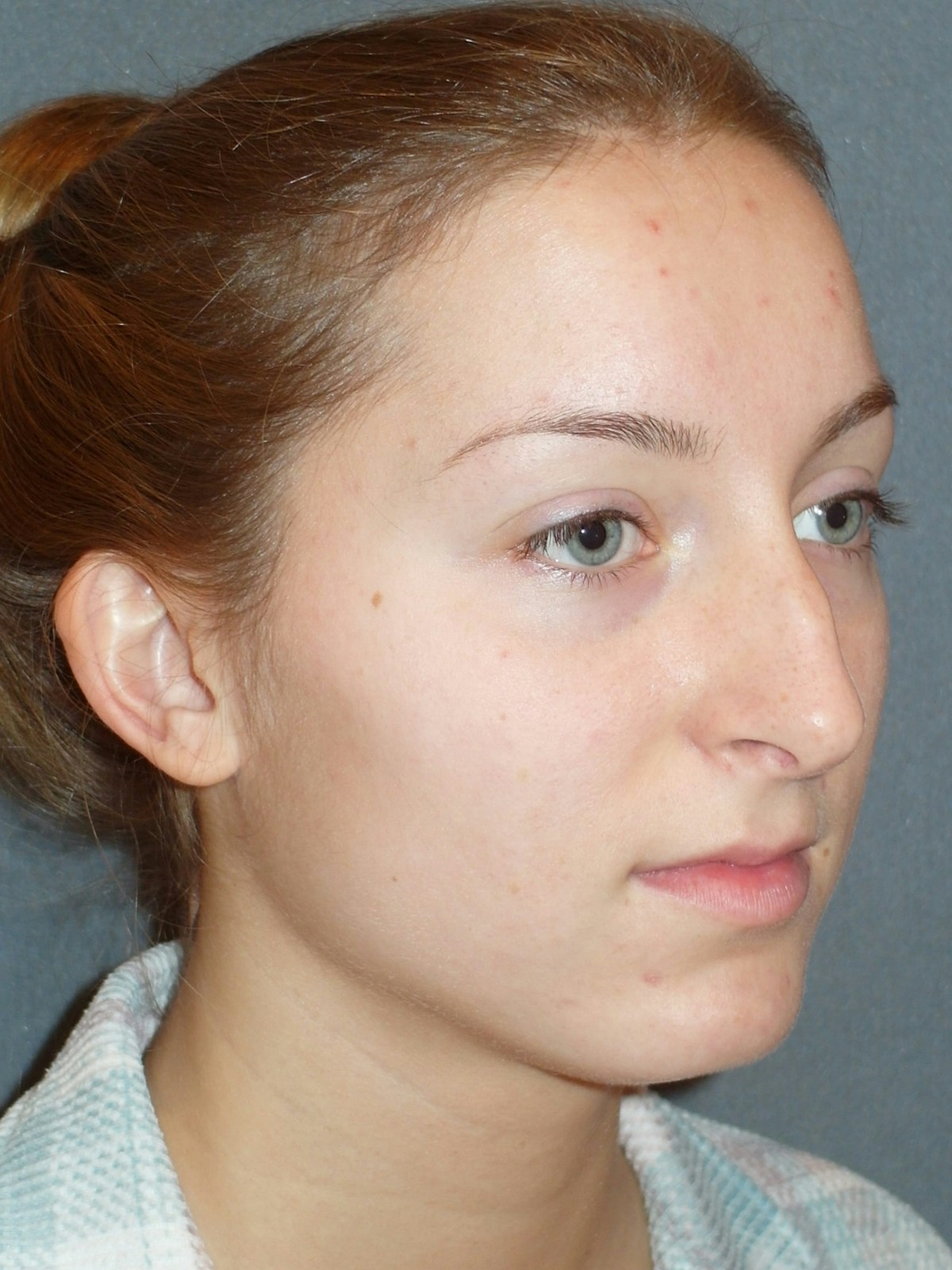 Rhinoplasty Before & After Gallery - Patient 445386 - Image 5