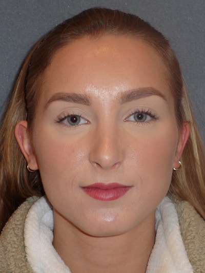 Rhinoplasty Before & After Gallery - Patient 445386 - Image 2