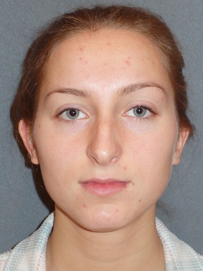 Rhinoplasty Before & After Gallery - Patient 445386 - Image 1