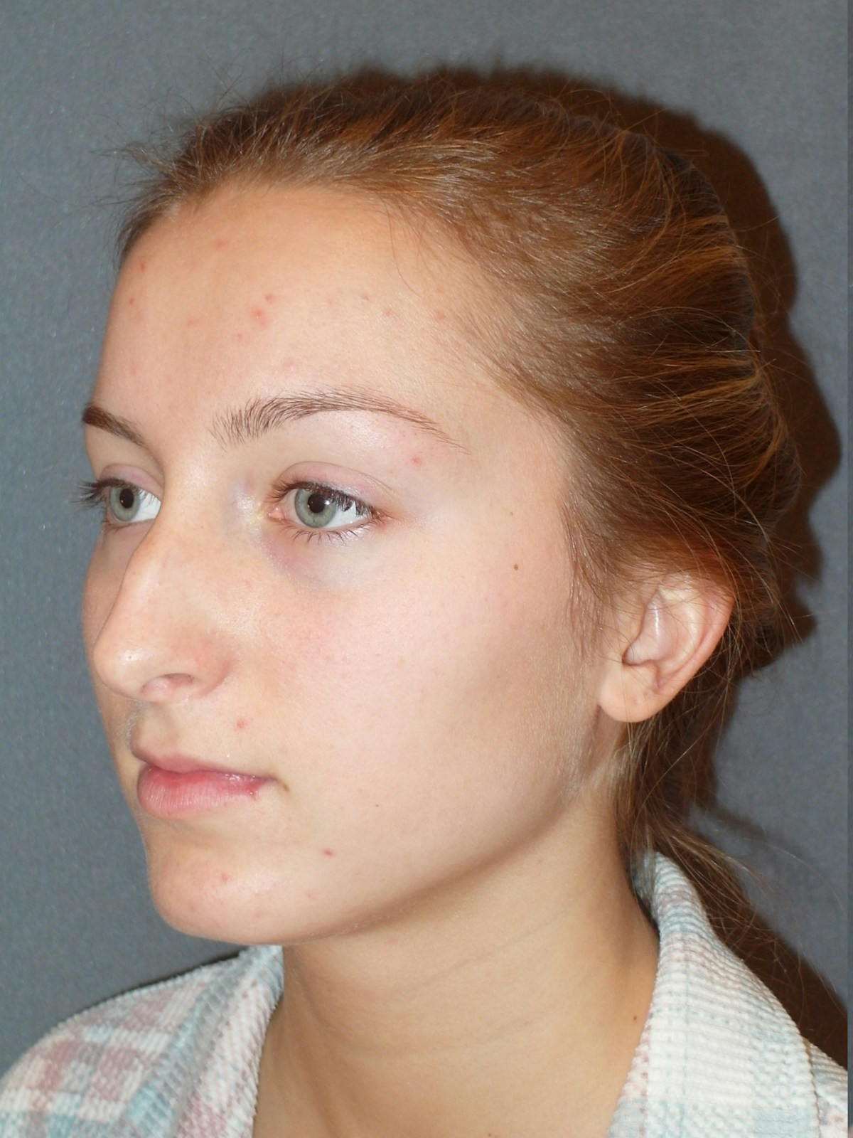 Rhinoplasty Before & After Gallery - Patient 445386 - Image 3