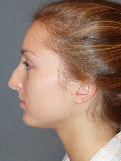 Rhinoplasty Before & After Gallery - Patient 445386 - Image 1
