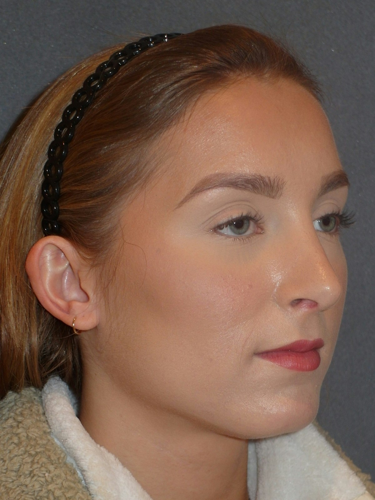 Rhinoplasty Before & After Gallery - Patient 445386 - Image 6