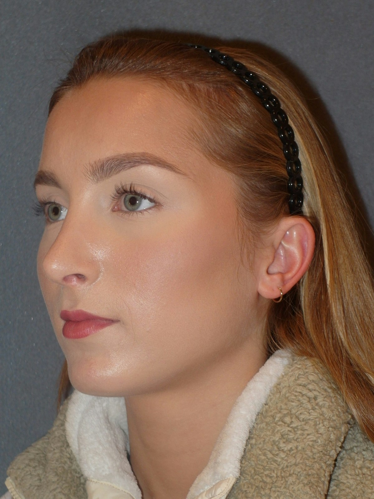 Rhinoplasty Before & After Gallery - Patient 445386 - Image 4