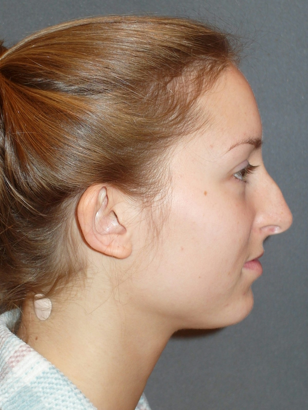 Rhinoplasty Before & After Gallery - Patient 445386 - Image 9