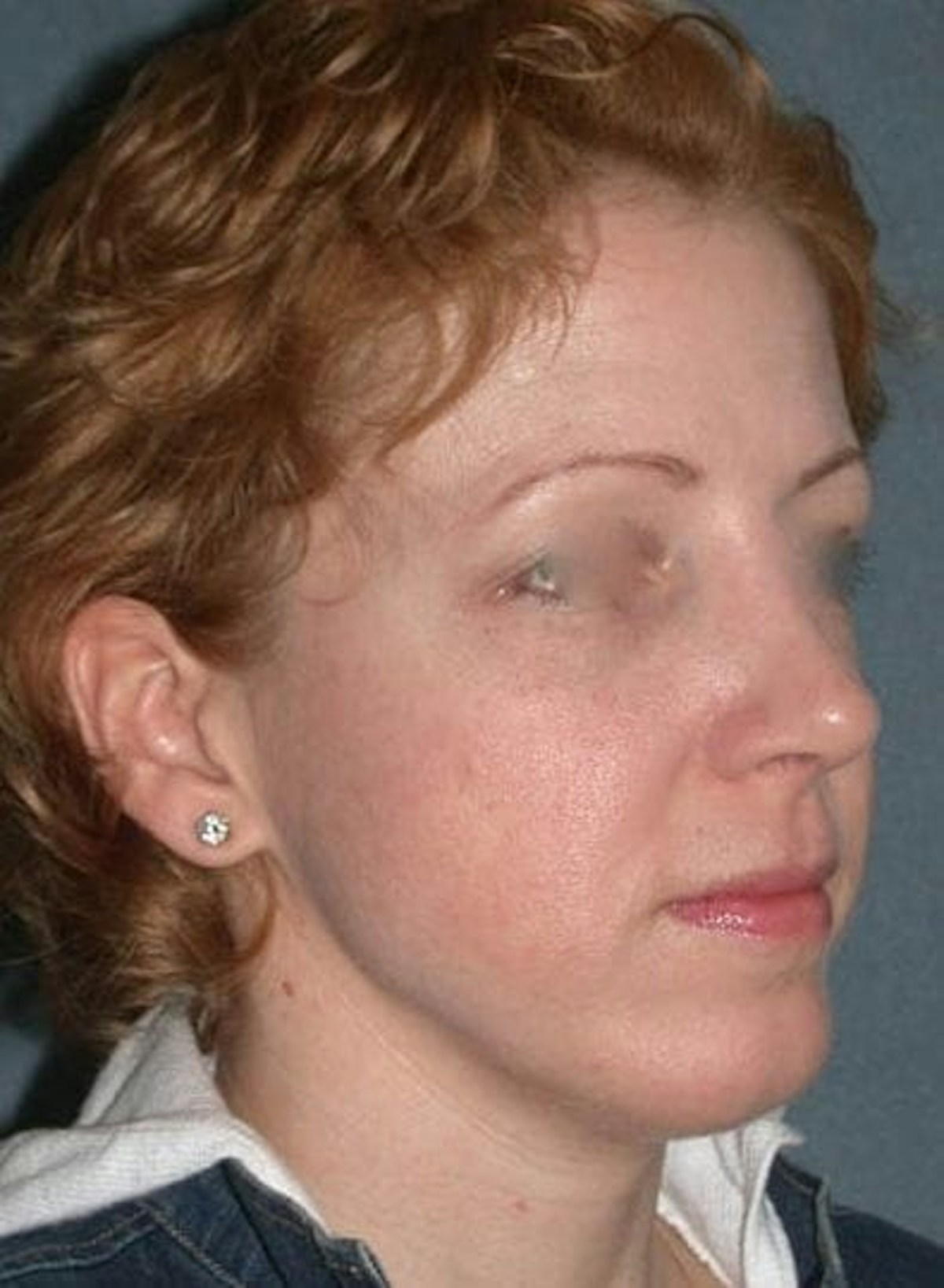 Rhinoplasty Before & After Gallery - Patient 155267 - Image 4