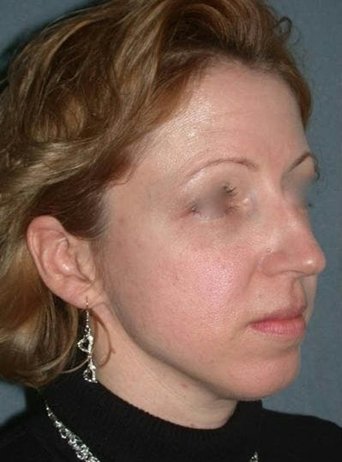 Rhinoplasty Before & After Gallery - Patient 155267 - Image 3