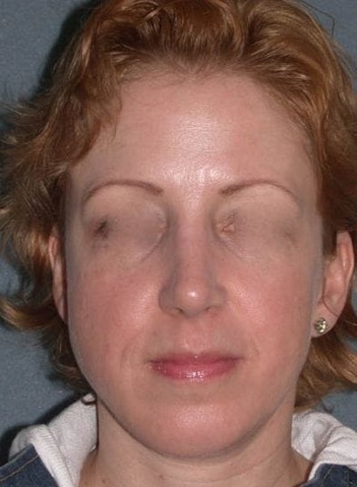 Rhinoplasty Before & After Gallery - Patient 155267 - Image 2