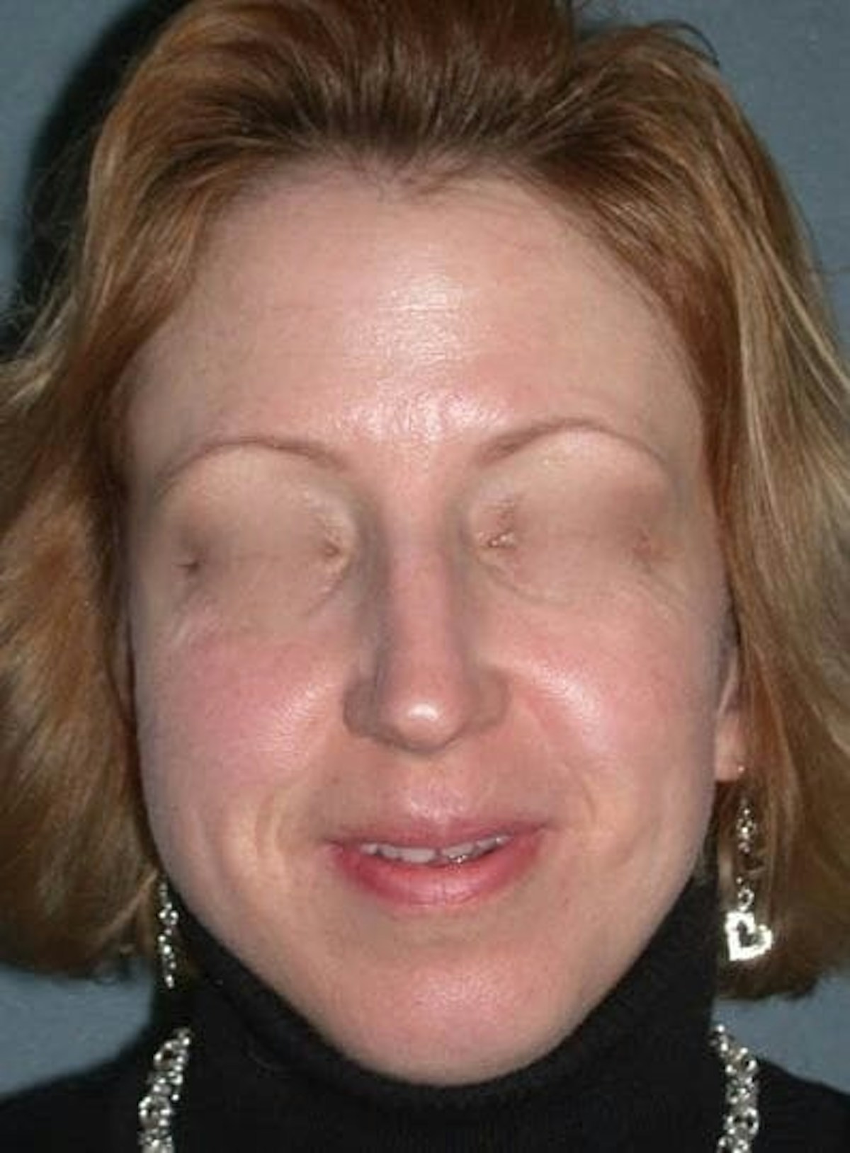 Rhinoplasty Before & After Gallery - Patient 155267 - Image 1